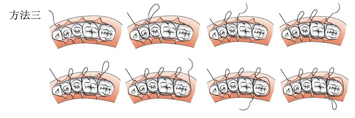 医用手术缝合线缝合方法.jpg